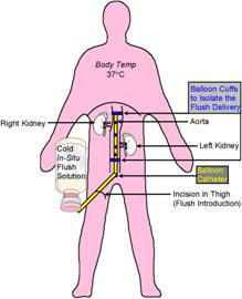 Illustration showing the in-situ flush solution