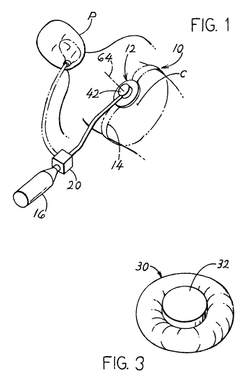 Illustration that  describes an automatic chest compression device for CPR