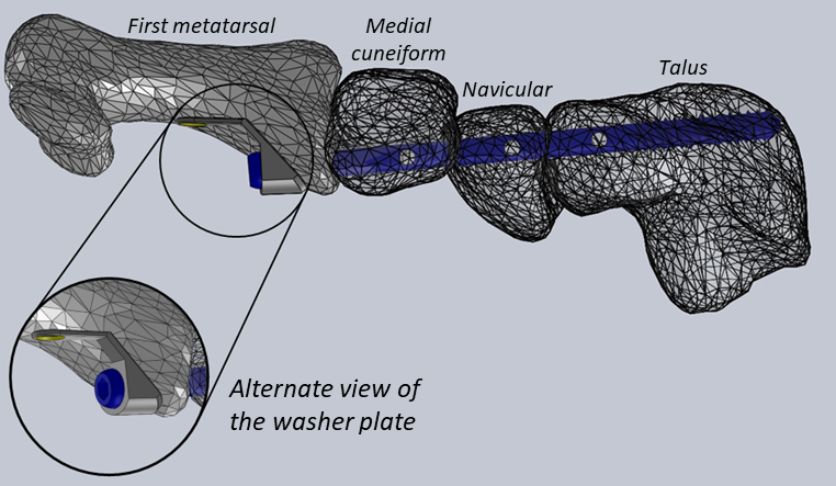 Depiction of the MECO implant in situ