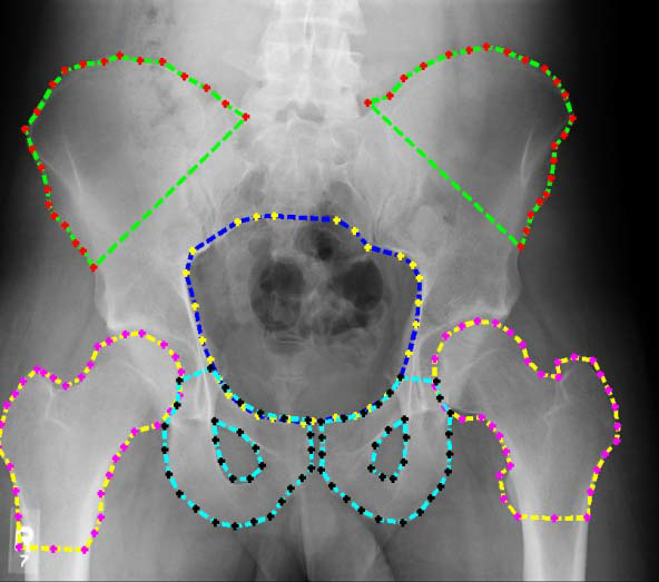 An X-ray of a pelvis.X